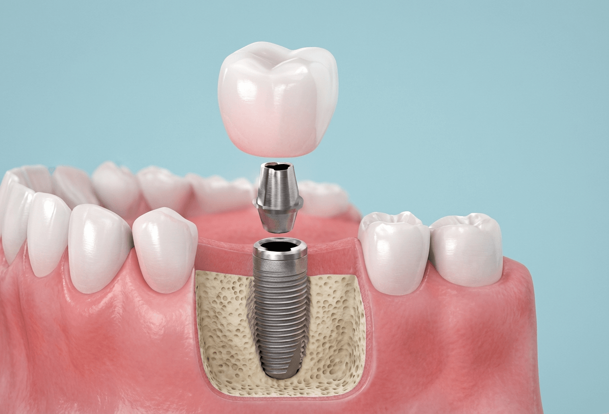 インプラント埋入イメージ