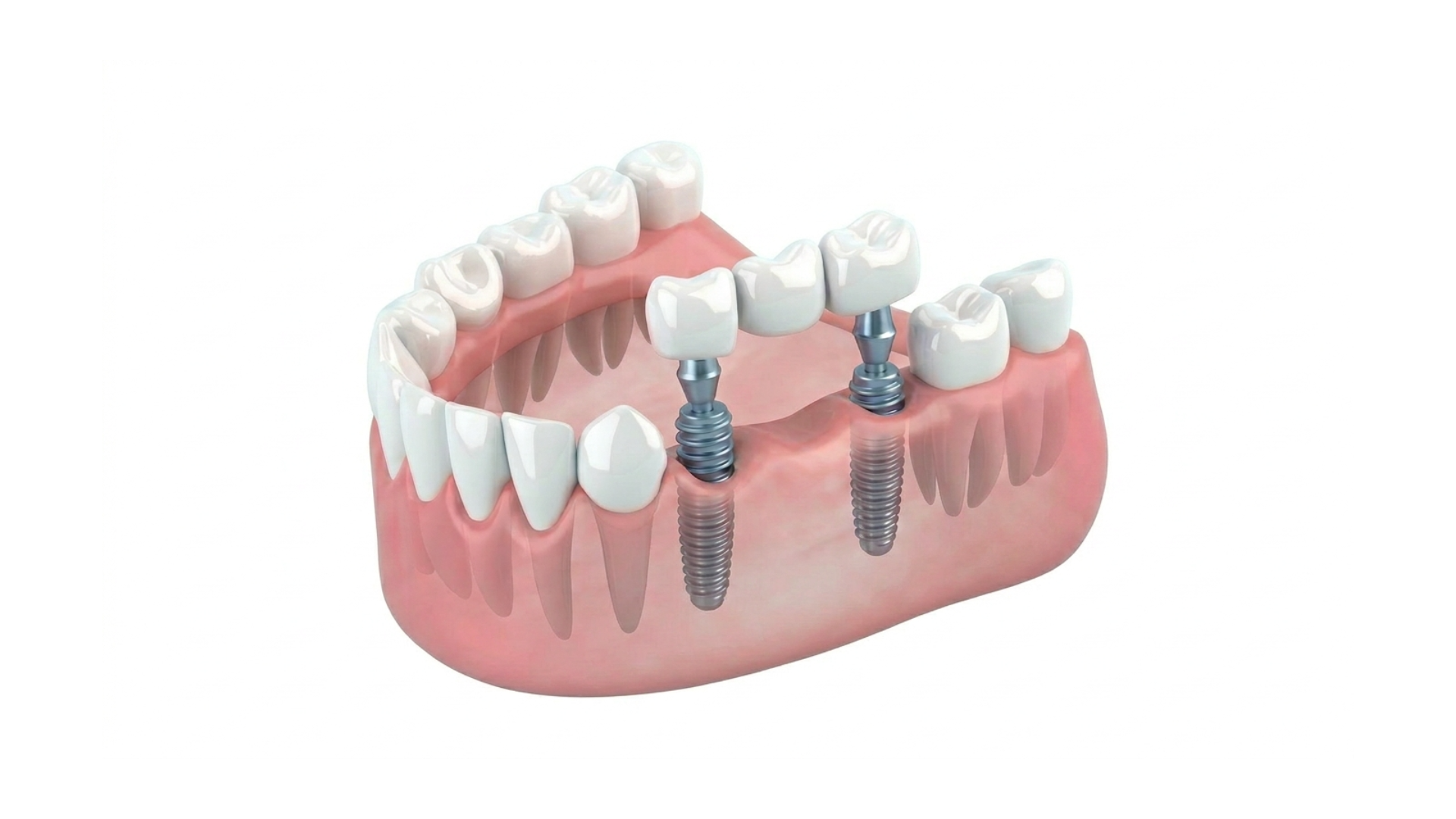 全体のインプラント治療